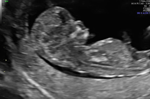 Ultrasound Specials for scans | Love at First Sight Ultrasound