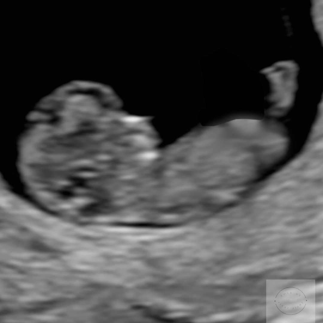 Love at First Sight Ultrasound